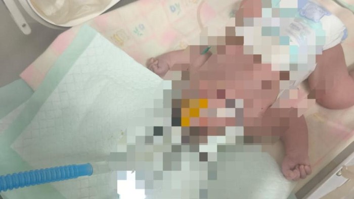 Bayi lahir tanpa tempurung kepala di RS Bhayangkara.