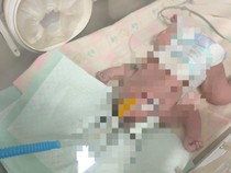 Bayi Tanpa Tempurung Kepala Lahir di Palembang, Keluarga Butuh Bantuan