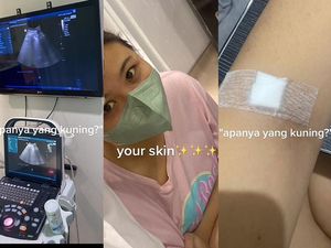 Awal Mula Wanita Tangsel Idap Gangguan Liver di Usia 21, Ini Gejala yang Dikeluhkan