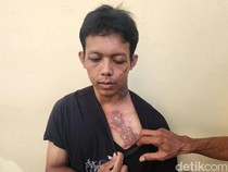 Bagus Disiram Air Keras oleh Paman Angkat hingga Luka di Sekujur Tubuh