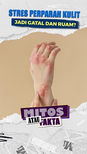 Video Mitos atau Fakta: Stres Tekanan Pekerjaan Memicu Eksim Kulit Lebih Parah