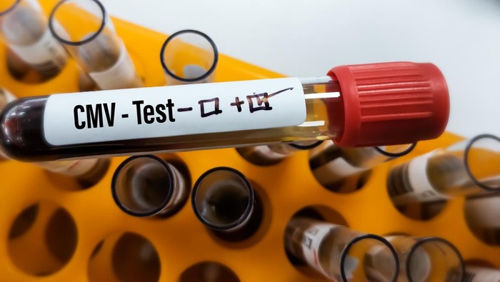 Infeksi Virus CMV Berpotensi Memperburuk Gejala Autisme