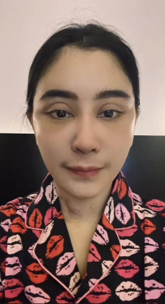 Di hari keenam setelah operasi, bengkak di wajah Uut terlihat sudah mulai berkurang. Hanya bagian lehernya masih terlihat ada lebam. Foto: Instagram/@uutpermatasari
