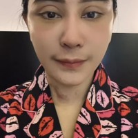 Di hari keenam setelah operasi, bengkak di wajah Uut terlihat sudah mulai berkurang. Hanya bagian lehernya masih terlihat ada lebam. Foto: Instagram/@uutpermatasari