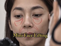 Most Popular: Foto Dinda Kirana Oplas Wajah Hingga Payudara di Korea