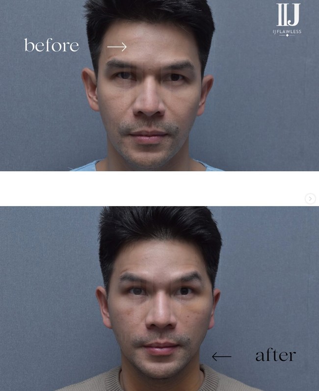Tindakan oplas yang dijalani Ijonk ialah mini facelift untuk menghilangkan pipi chubbynya. Klinik kecantikan tempatnya menjalani oplas pun membagikan foto perbedaan wajah Ijonk sebelum dan setelah tindakan. Foto: Instagram/@ij.flawless