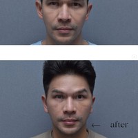 Tindakan oplas yang dijalani Ijonk ialah mini facelift untuk menghilangkan pipi chubbynya. Klinik kecantikan tempatnya menjalani oplas pun membagikan foto perbedaan wajah Ijonk sebelum dan setelah tindakan. Foto: Instagram/@ij.flawless