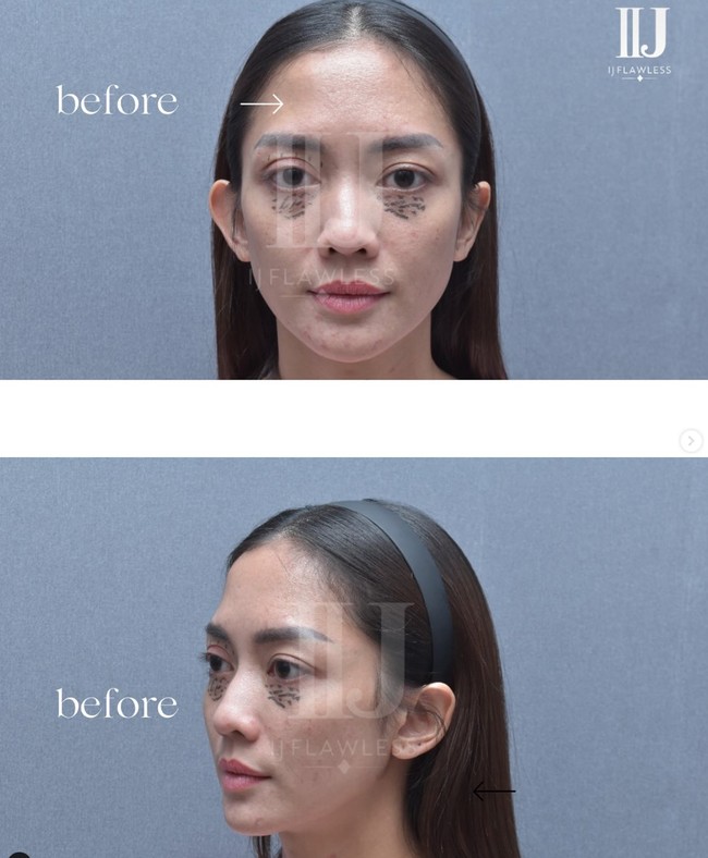 Tak hanya Ijonk, klinik tersebut juga membagikan foto-foto Ririn sebelum dan setelah menjalani perawatan. Sayangnya tidak dijelaskan jenis perawatan apa yang dijalani aktris 39 tahun itu. Namun dalam foto terlihat area mata, khususnya bagian bawah mata Ririn tampak ditandai. Foto: Instagram/@ij.flawless