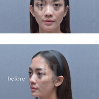 Tak hanya Ijonk, klinik tersebut juga membagikan foto-foto Ririn sebelum dan setelah menjalani perawatan. Sayangnya tidak dijelaskan jenis perawatan apa yang dijalani aktris 39 tahun itu. Namun dalam foto terlihat area mata, khususnya bagian bawah mata Ririn tampak ditandai. Foto: Instagram/@ij.flawless