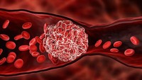 7 Tanda Pembekuan Darah yang Kerap Tak Disadari, Bisa Picu Stroke-Serangan Jantung