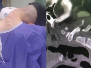 Ngeri! Pemuda Ini Kena Sindrom Kepala Jatuh, Lehernya Melemah dan Bengkok