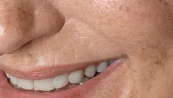 Normal untuk memiliki smile line atau garis-garis saat tersenyum. Foto: pikisuperstar via Bright Side