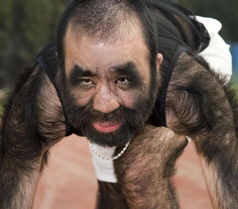 Beberapa orang terlahir dengan kelebihan yang tak dimiliki yang lain, misalnya polydactyly yang memiliki ekstra jari tangan atau kaki. Ini dia di antaranya.