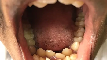 Hyperdontia adalah kondisi langka di mana ada tambahan gigi yang tumbuh di dalam mulut. Biasanya tumbuh di belakang atau dekat gigi permanen. Foto: 100Camomille/Wikimedia Commons via Bright Side