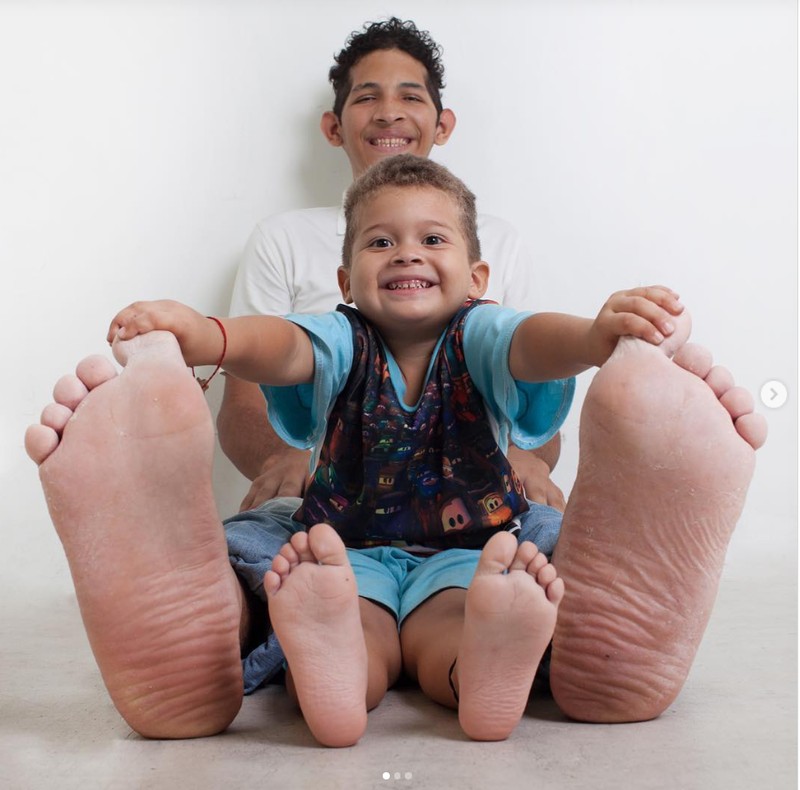 Beberapa orang terlahir dengan kelebihan yang tak dimiliki yang lain, misalnya polydactyly yang memiliki ekstra jari tangan atau kaki. Ini dia di antaranya.