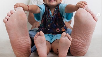 Jeison Orlando Rodríguez Hernandez punya kaki raksasa. Kakinya terus bertumbuh hingga 40 cm pada 2014. Dia pun menjalani terapi agar kakinya tidak tumbuh semakin tinggi. Foto: Guinness World Records via Bright Side