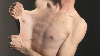 Kulit Garry Turner sangat elastis karena sindrom Ehlers-Danlos yang dia idap. Penyakit ini memengaruhi jaringan ikat dan menyebabkan kulit mengendur serta hipermobilitas sendi. Kulit Turner di perutnya dapat diregangkan hingga sepanjang 6,2 inch (15,8 cm). Foto: Guinness World Records via Bright Side