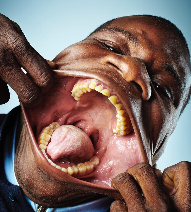 Beberapa orang terlahir dengan kelebihan yang tak dimiliki yang lain, misalnya polydactyly yang memiliki ekstra jari tangan atau kaki. Ini dia di antaranya.