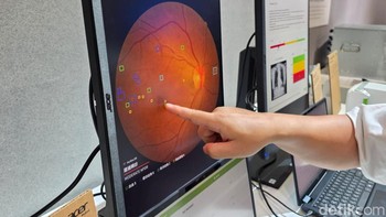 Perangkat lunak ini memanfaatkan teknik pembelajaran mendalam AI untuk menghasilkan hasil diagnosis yang mirip dengan dokter mata profesional. Perangkat lunak ini diklaim memiliki akurasi penyaringan sebesar 93%. Foto: Fino Yurio Kristo/detikINET