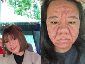 Viral Bumil Wajahnya Berubah Drastis saat Hamil, Ternyata Ini Penyebabnya