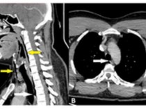 Ngilu, Trakea Pria Umur 30 Tahun Robek gegara Nekat Tahan Bersin
