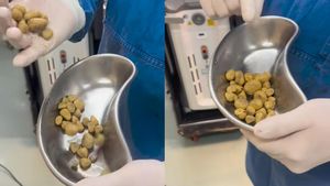 Sederet Kasus Medis Batu di Tubuh Pasien, Ada di Ginjal hingga Miss V