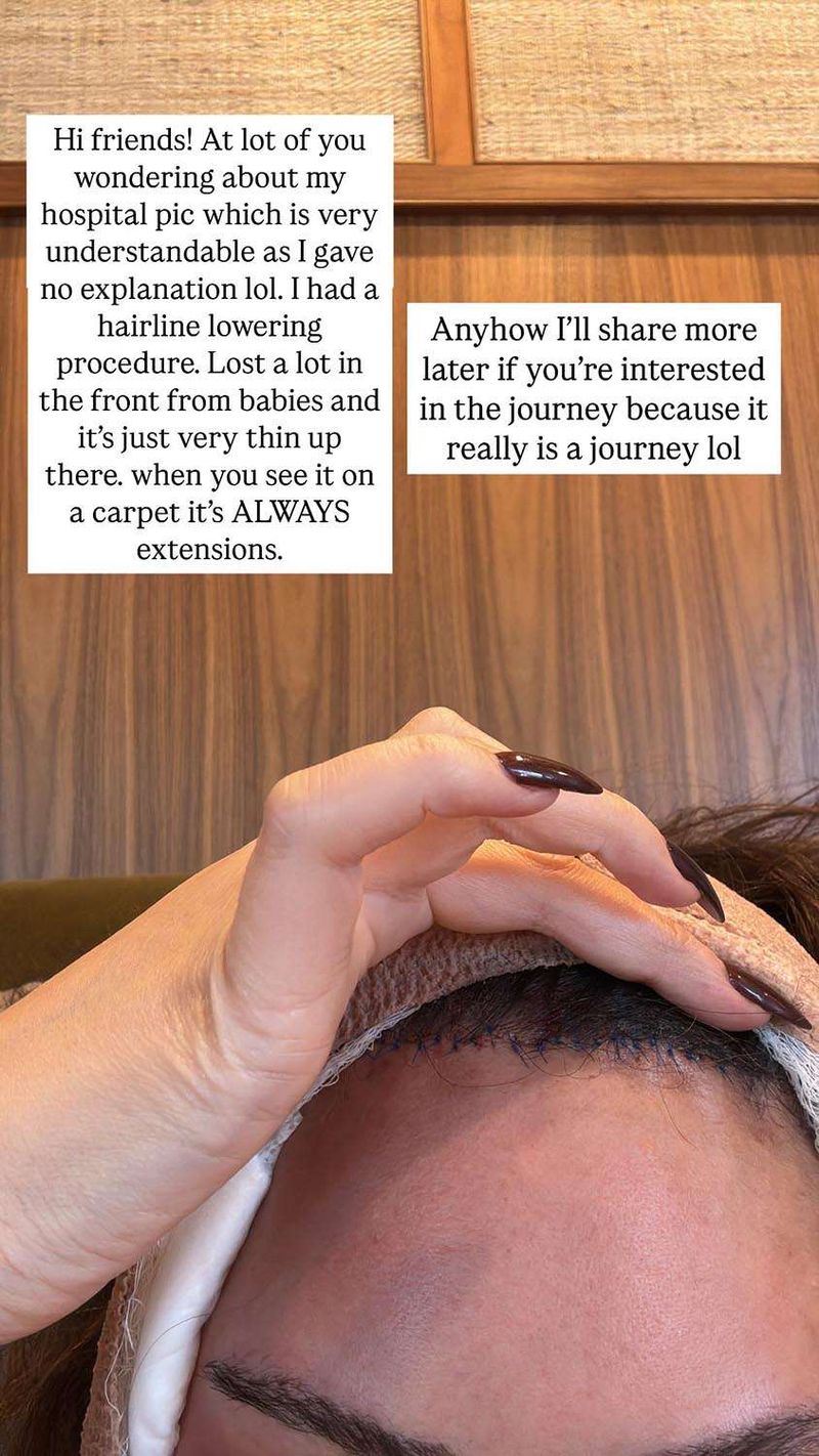 Chrissy Teigen jalani prosedur penurunan garis rambut.