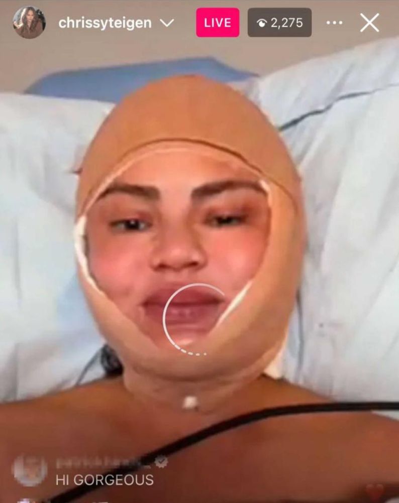 Chrissy Teigen jalani prosedur penurunan garis rambut.