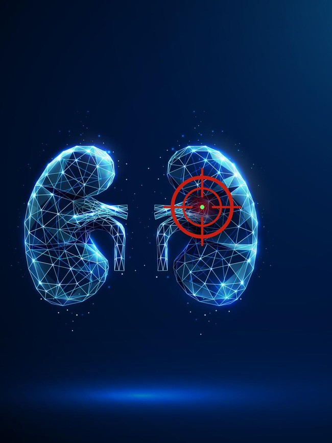 Gaya Hidup dan Pola Makan Seperti Ini Tingkatkan Risiko Kanker Ginjal