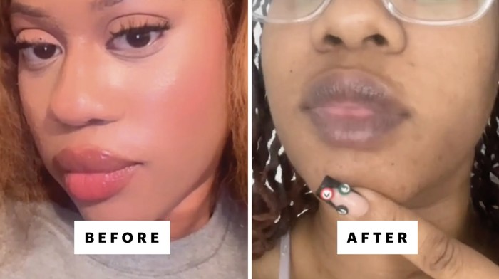 Ilustrasi benjolan di bibir