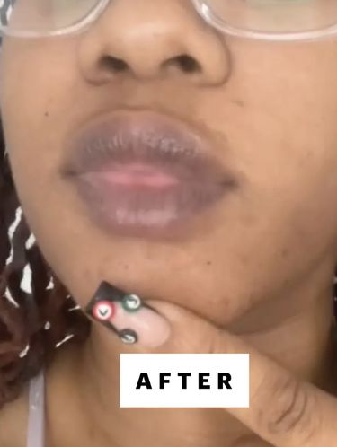 Wanita yang Keluhkan Bibir Menghitam Setelah Pakai Lip Oil