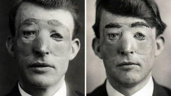 Walter Yeo, pelaut Perang Dunia I, kehilangan kelopak matanya dalam pertempuran mengerikan. Namun, ia menjadi salah satu orang pertama yang menjalani operasi plastik canggih oleh Harold Gillies, bapak bedah plastik modern. Gillies menggunakan teknik cangkok kulit pedikel tabung yang revolusioner untuk merekonstruksi wajah Yeo. Meski belum sempurna, operasi ini menjadi terobosan medis besar, menawarkan harapan bagi tentara yang terluka dan membuktikan ketahanan manusia serta kekuatan transformatif kedokteran dalam memulihkan identitas dan martabat. Foto: Boredpanda