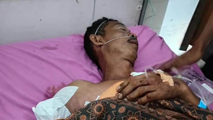 Kondisi Herman, peternak udang di OKI pasca operasi setelah diterkam buaya.