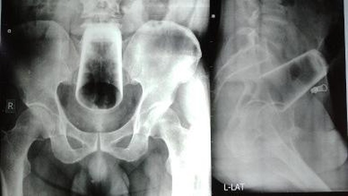 Benda aneh masuk di anus - gelas