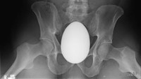 Seorang pria 41 tahun di Amerika Serikat dibawa ke unit gawat darurat dengan keluhan nyeri panggul hebat, akibat benda besar berbentuk oval dimasukkan 2 jam sebelum pasien datang. Setelah dicek dokter, itu adalah kelereng berbentuk telur. (Foto: International Journal of Surgery Case Reports)
