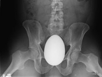 Hasil Foto X-Ray yang Bikin Geleng-geleng, Temuan Benda Aneh Nyangkut di Anus