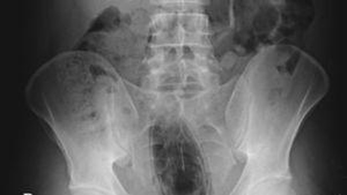 Benda asing masuk anus - tutup deodoran