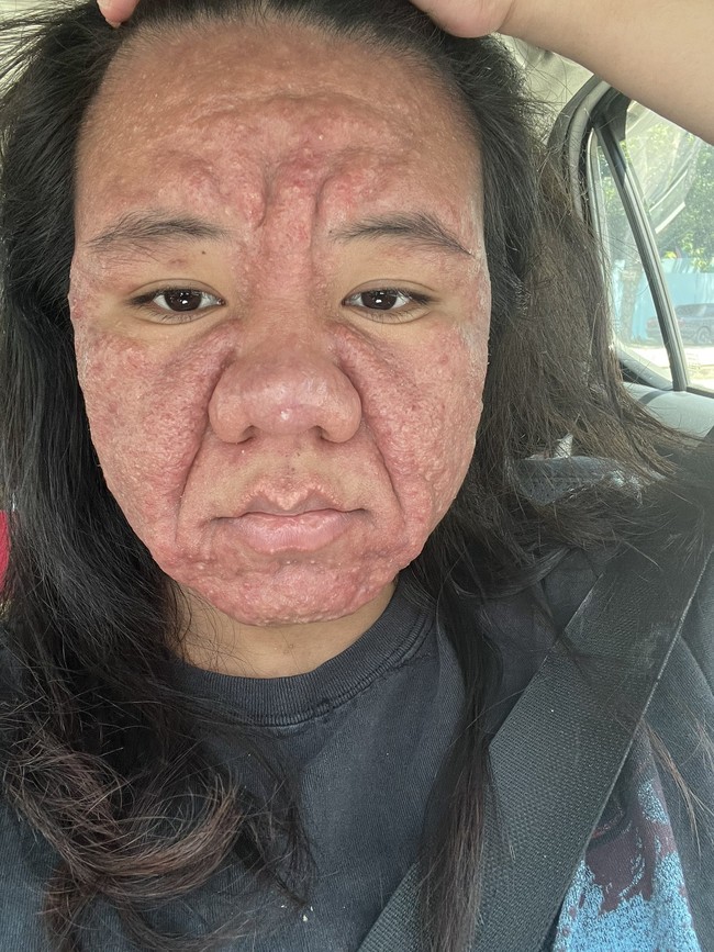 Sekarang hamil delapan bulan, Farah bergulat dengan kelainan kulit langka yang telah mengubah penampilannya dan menguji kepercayaan dirinya. Wanita yang bekerja sebagai marketing manager ini juga mengalami pembengkakan di hidung. Foto: X/@ayyitslala