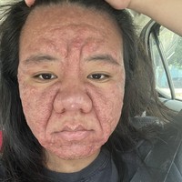 Sekarang hamil delapan bulan, Farah bergulat dengan kelainan kulit langka yang telah mengubah penampilannya dan menguji kepercayaan dirinya. Wanita yang bekerja sebagai marketing manager ini juga mengalami pembengkakan di hidung. Foto: X/@ayyitslala