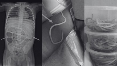 Momen Dokter Temukan Cacing Hidup di Tubuh Manusia, Foto-fotonya Bikin Merinding