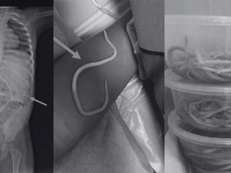 Momen Dokter Temukan Cacing Hidup di Tubuh Manusia, Foto-fotonya Bikin Merinding