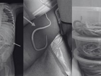 Momen Dokter Temukan Cacing Hidup di Tubuh Manusia, Foto-fotonya Bikin Merinding