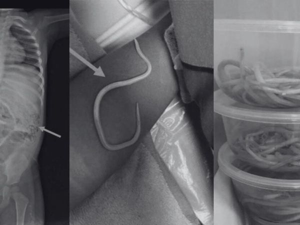Momen Dokter Temukan Cacing Hidup di Tubuh Manusia, Foto-fotonya Bikin Merinding