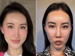 Viral Wanita Jalani 5 Kali Operasi Hidung karena Bosan dengan Wajahnya