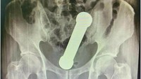 Seorang pria di Brasil mengeluhkan sakit perut. Ternyata ada barbel yang menyangkut di anusnya selama dua hari. (International Journal of Surgery Case Reports)