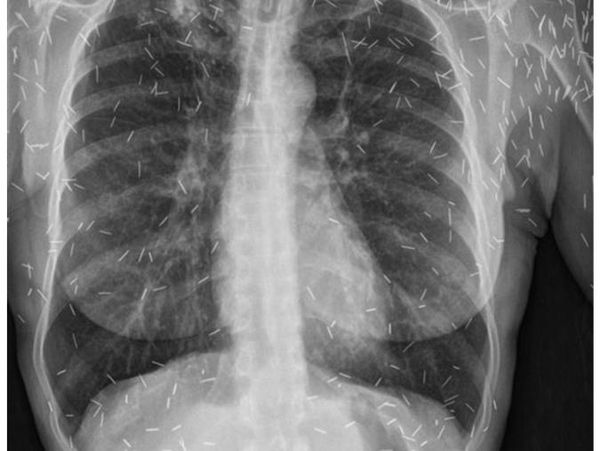 Foto Rontgen di Luar Nalar, Barang Aneh di Tubuh Termasuk Benda Diduga Susuk