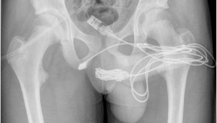 kabel usb nyangkut di penis