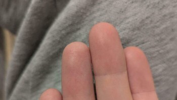 Seseorang Mematahkan Jari Manisnya dan Setelah Tidak Membengkokkannya Selama Beberapa Saat, Lipatan Pada Sendi Atas Hilang Foto: Boredpanda