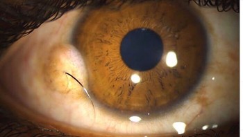 Rambut Tumbuh Di Mata Foto: Boredpanda