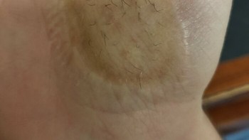 Telapak Tangan Tumbuh Rambut Setelah Cangkok Kulit Setelah Beberapa Tahun Foto: Boredpanda